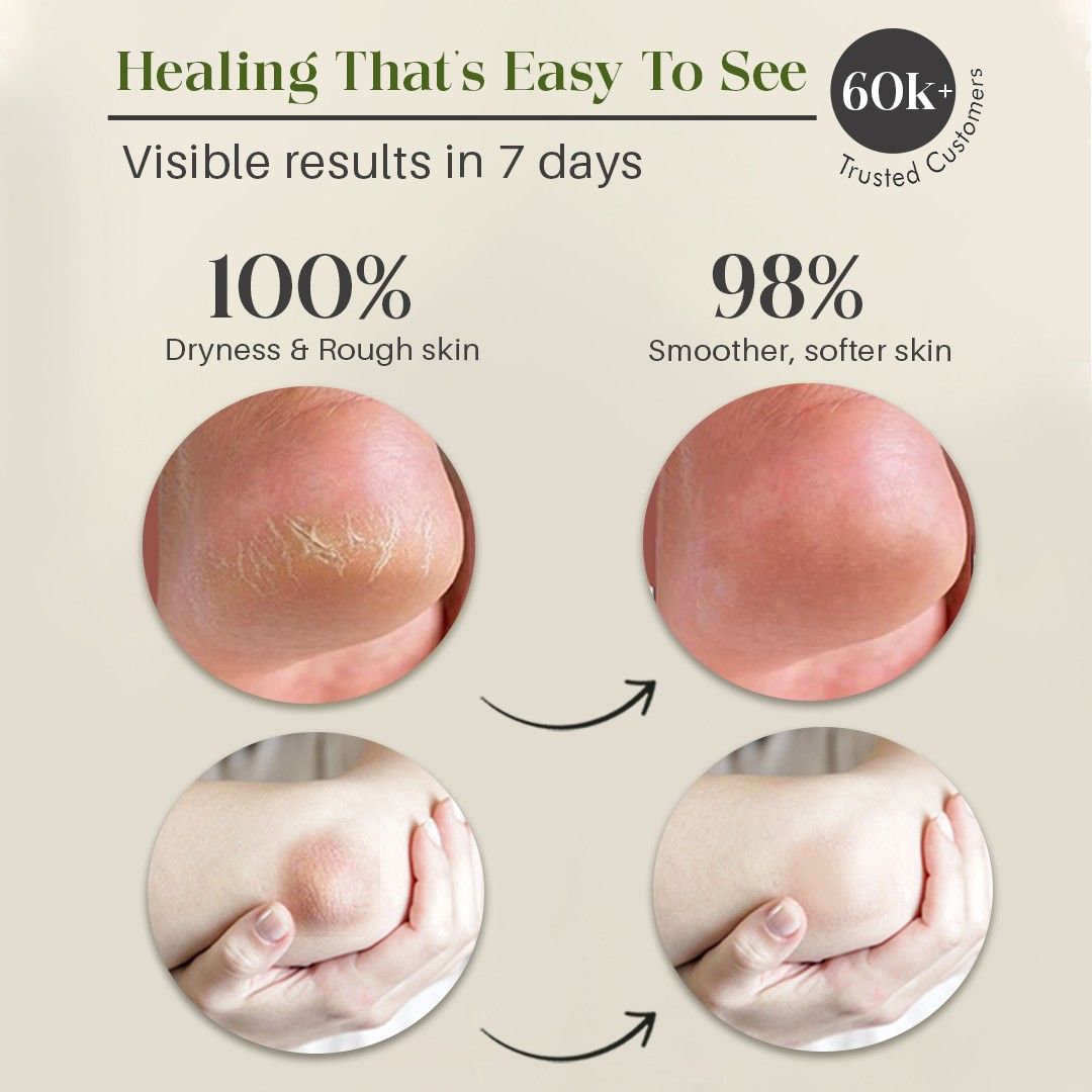 Hand & Foot Cream For Cracked Heals