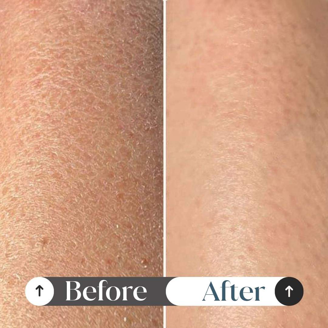 10% Urea Body Lotion for Very Dry & Rough Skin