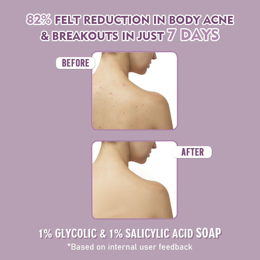 1% Glycolic Acid & 1% ww Salicylic Acid Body Acne Soap Pack of 3